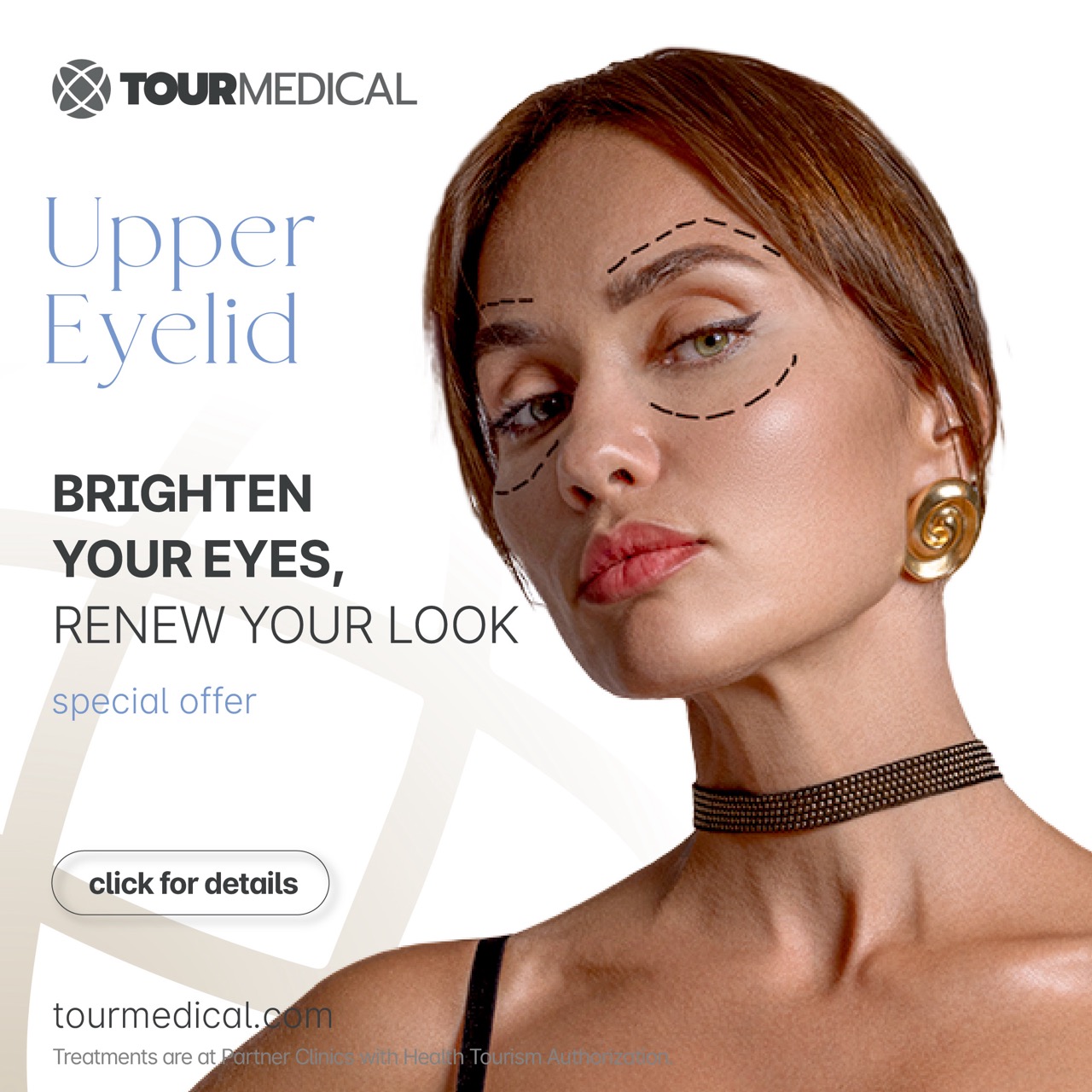 Upper Eyelid Offer img